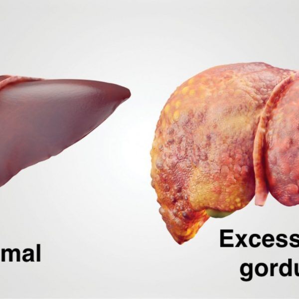 Gordura no fígado: fique atento ao perigo