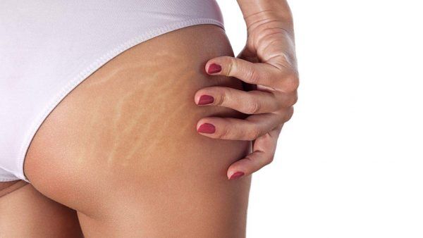Estrias: Marcas da evolução