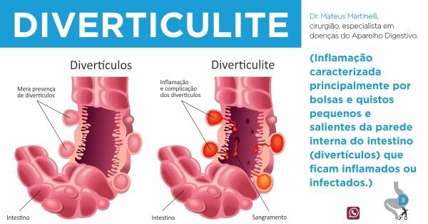 Saiba como prevenir a diverticulite